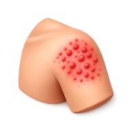 Allergy Rash 3D icon